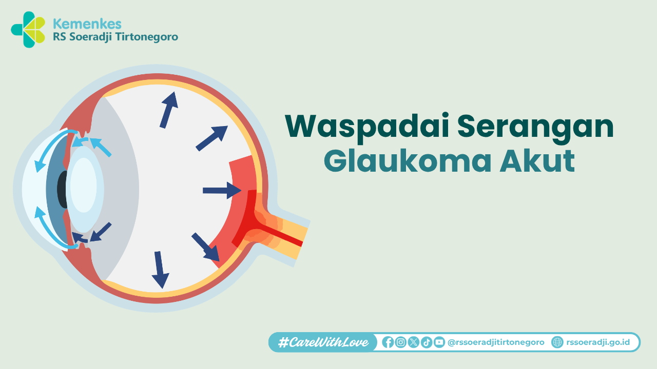 Waspadai Serangan Glaukoma Akut