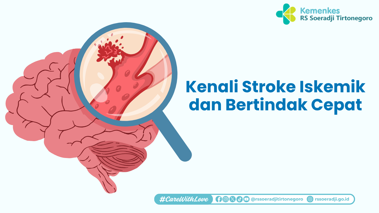 Kenali Stroke Iskemik dan Bertindak Cepat