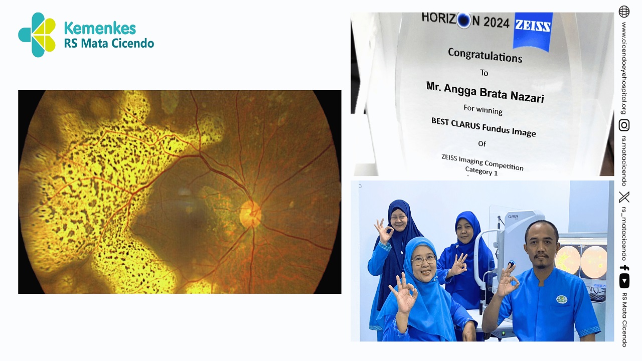A Leopard Fish Inside The Right Eye Mend